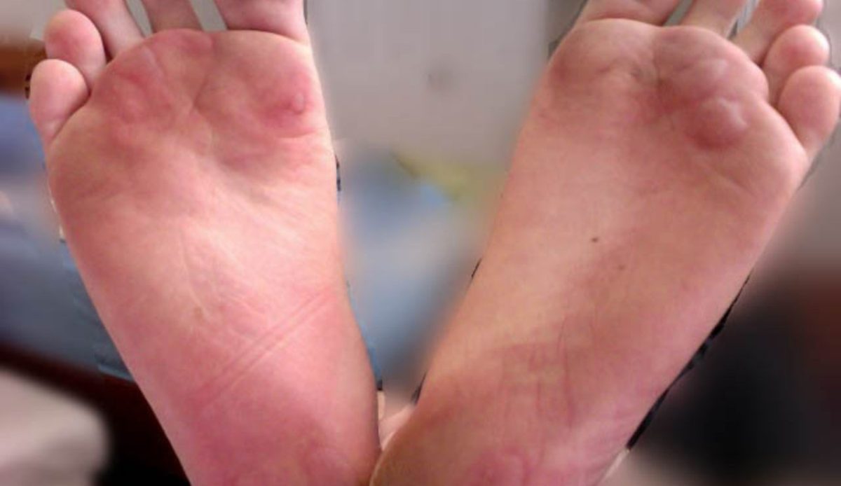 10 Essential Hiking Skills You Need Before Tackling Serious Trails 7 blister on feet